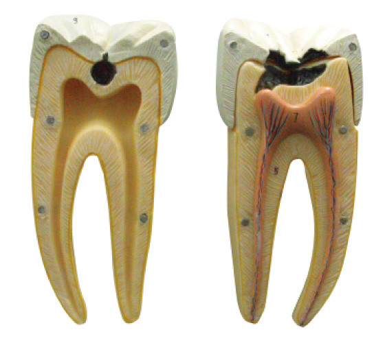 À l'initiale et aux étapes avancées du modèle de carie dentaire pour apprendre et former