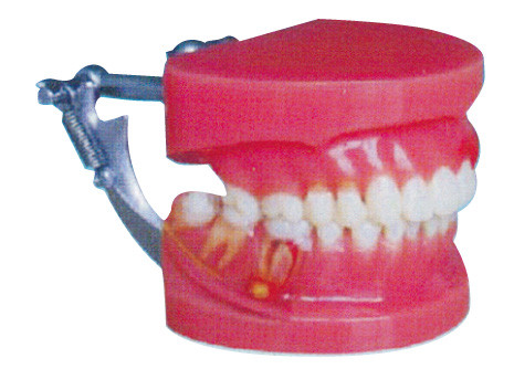 Le Général modèle le docteur de maladie parodontale de dents humaines rouges et blanches de démonstration