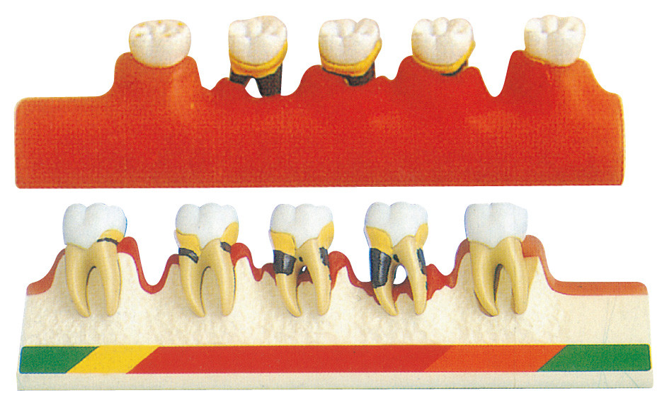 Le modèle de maladie parodontale inclut 5 parts pour la formation d'écoles dentaires