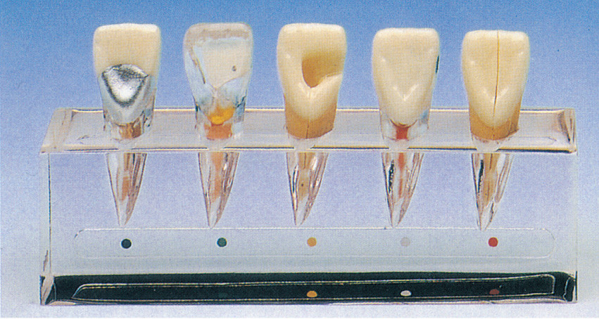 Modèle clinique de série de la maladie de dent environ 5 parts pour la formation d'écoles dentaires