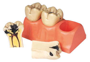 Modèle humain disséqué de dents de la maladie dentaire pour le stage et la formation d'étudiants